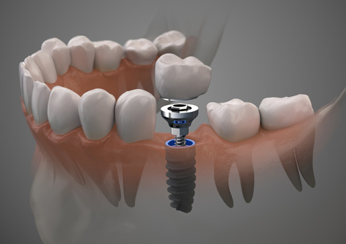 Dental prosthetic innovation