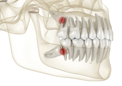 Mesial impaction of Wisdom teeth
