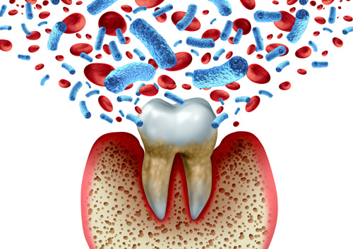Tooth decay and blood bacteria and disease