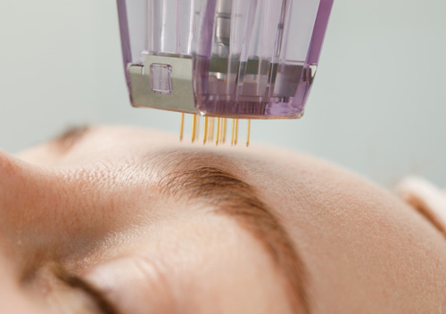 Microneedle mesotherapy